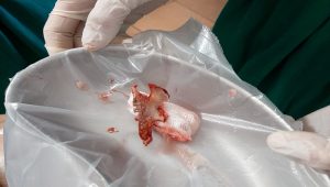 TTYT Huyện Văn Chấn-Tỉnh Yên Bái Nội Soi, Gắp Xương Gà Kích Thước Lớn Trong Lòng Thực Quản Bệnh Nhân
